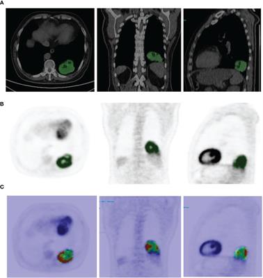A Pilot Study of Radiomics Models Combining Multi-Probe and Multi-Modality Images of 68Ga-NOTA-PRGD2 and 18F-FDG PET/CT for Differentiating Benign and Malignant Pulmonary Space-Occupying Lesions